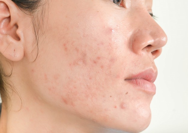 Doğal Ürünlerle Sivilce Tedavisi - Acne Treatment with Natural Products