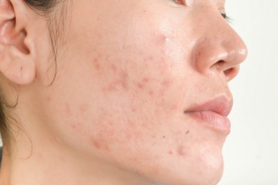 Doğal Ürünlerle Sivilce Tedavisi - Acne Treatment with Natural Products