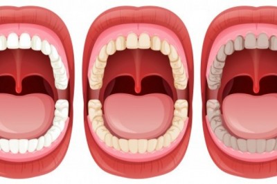 AFT VE AĞIZ YARASINDAN ESER KALMAZ!! SAFT ve AĞIZ YARASINA KARŞI MUCİZE BULUŞ